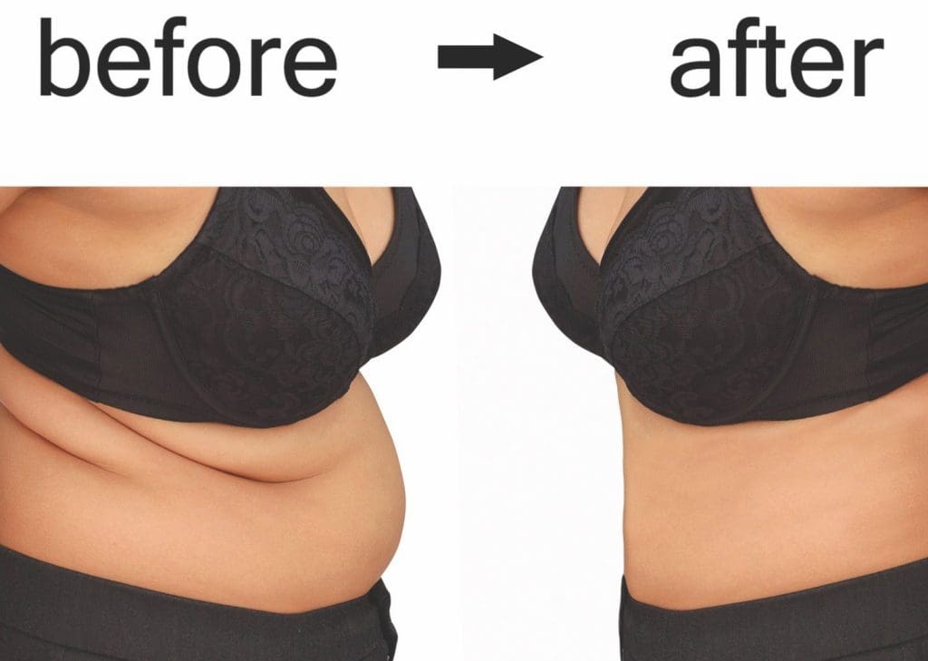 New Lipo Procedure Comes With Popular Improvements | Coastal Virginia  Magazine